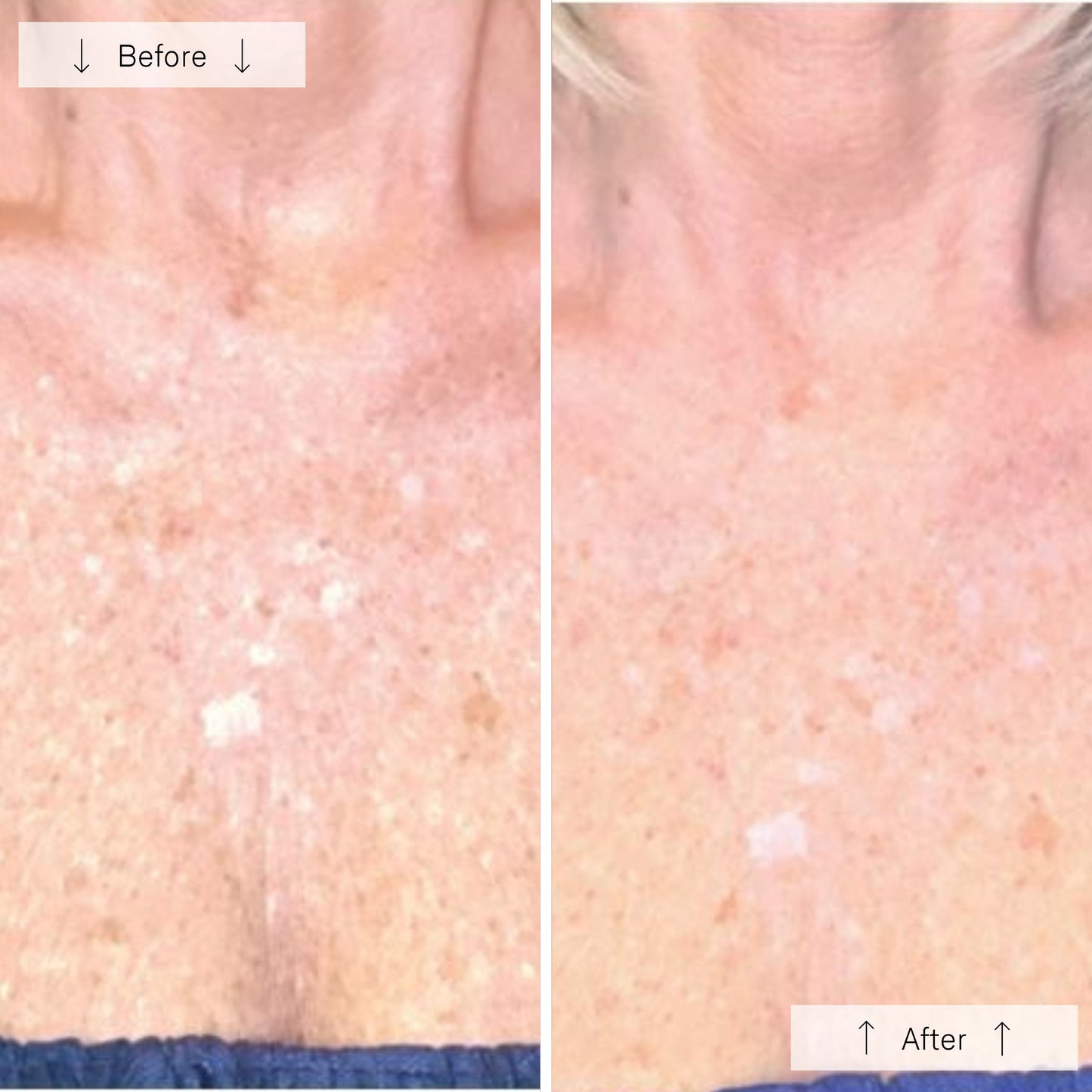 Omnilux Contour Neck & Décolleté